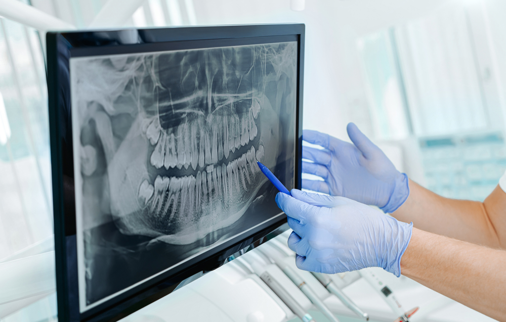 Dentist reviewing a panoramic dental X-ray on a monitor